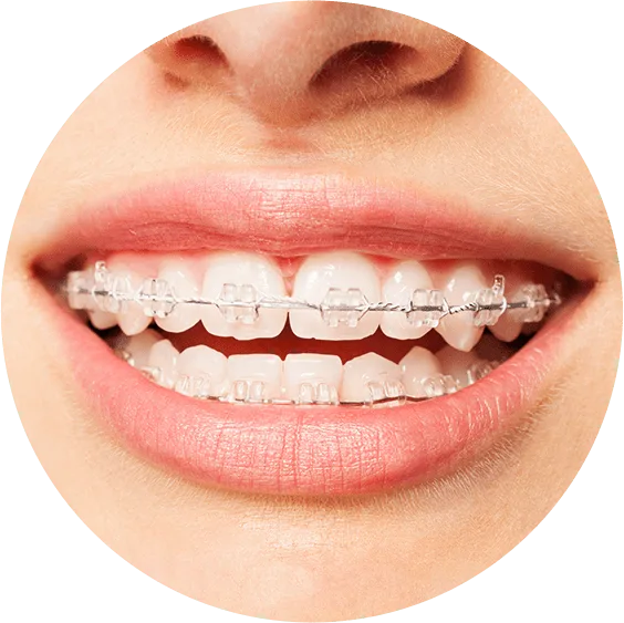 How a root canal procedure is done - Step by step pictorial.