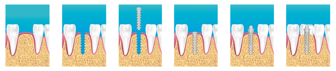How a dental implant is placed - Step by step pictorial.