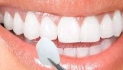 Types of dentures